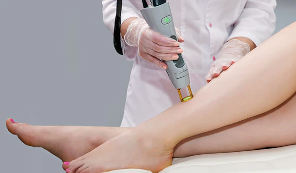 Laser hair removal procedure at Viva La Skin, Raipur