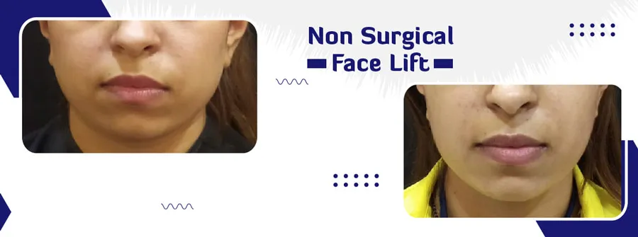 Advanced Skin Treatment at Viva La Skin Clinic